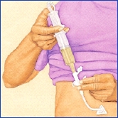 Hand pressing plunger on syringe filled with liquid food attached to feeding tube port.