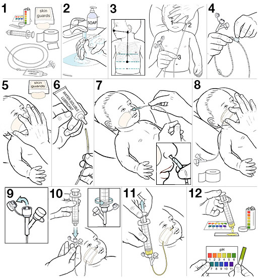 12 steps for placing an NG tube for your baby