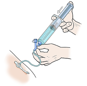 Hands using syringe to flush tube feeding port with water.