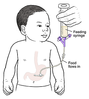 Outline of baby with tube inserted in stomach. Feeding port is near skin, and clamp is open on extension tubing. Feeding syringe is inserted into extension tubing. Liquid food flows into baby's stomach.