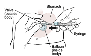 Front view of abdomen showing gastrostomy tube, balloon, and syringe. Hands connecting syringe to gastrostomy tube.
