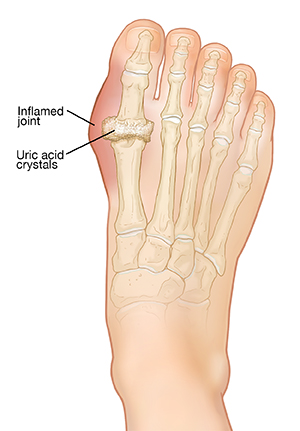 Top view of foot showing bones of the foot with a gout inflammation and uric acid crystals.