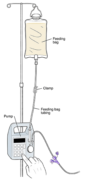 Feeding bag hanging from pole on pump. Feeding bag tubing goes from bag to pump. Clamp is in middle of tubing.