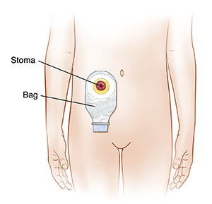 Outline of child's abdomen showing ostomy bag on stoma.