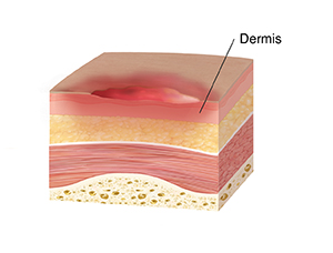 Cross section of skin, muscle. and bone showing stage two pressure injury, showing partial-thickness skin loss.