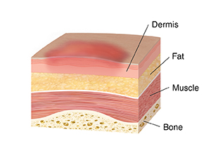 Cross section of skin, muscle. and bone showing stage one pressure injury. Top layers of skin are inflamed.