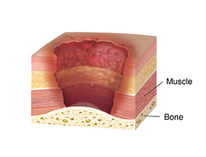 Cross section of skin, muscle. and bone showing stage four pressure injury, showing full thickness skin loss with exposed muscle and bone.