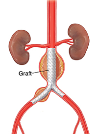 Front view of abdominal aorta with aneurysm showing graft in place.