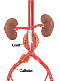 Front view of abdominal aorta with aneurysm showing catheter guiding graft into place.