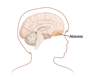 Outline of child's head turned to side showing head and brain. Abscess is in front part of brain. 