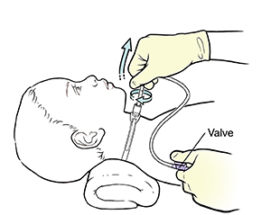 Child lying on back with pillow under neck. Gloved hand twisting suction tube while removing it from child's tracheostomy. Other hand covering suctioning tube valve with thumb.