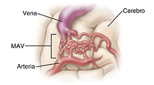 Primer plano de una malformación arteriovenosa (MAV) en el cerebro. Primer plano de un aneurisma en el cerebro.