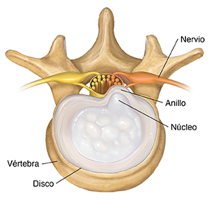 Vista superior de una vértebra lumbar que muestra un disco herniado contenido.